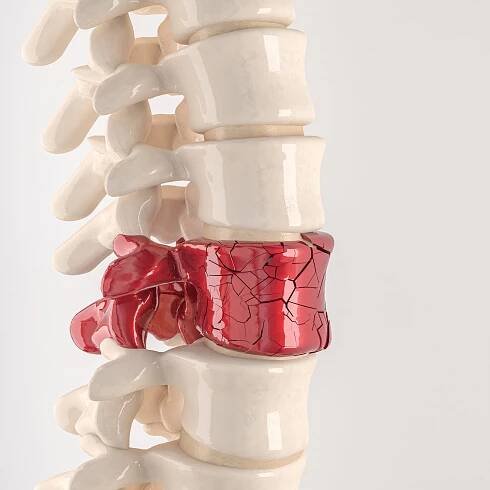 Cvičenie na zlepšenie výsledkov po osteoporotickej vertebrálnej zlomenine » VedaZdravieSport.sk - Dosiahni s nami svoje ciele!