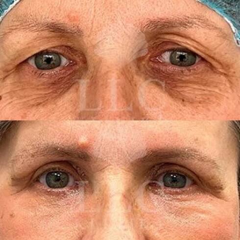 Blefaroplastika víček 