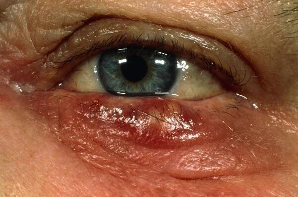 Chalazion and Hordeolum (Stye) - Eye Disorders - Merck Manual Professional Edition