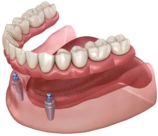 mandibulární odnímatelná protéza vše na 2 systému podporované implantáty s kuličkovými nástavci. lékařsky přesná zubní 3d ilustrace - zubní protéza - stock snímky, obrázky a fotky