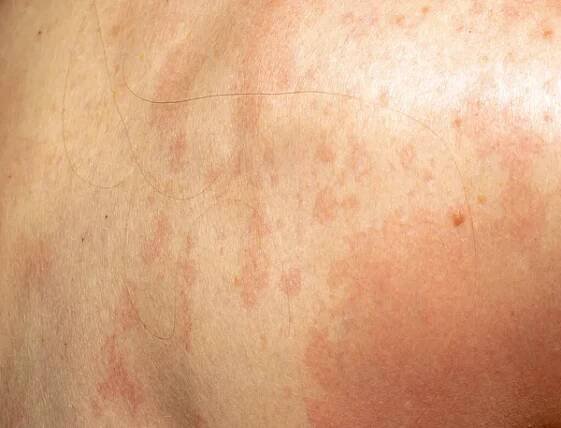 Psoriáza zdravotní stav červené skvrny na kůži zpět — Stock obrázek