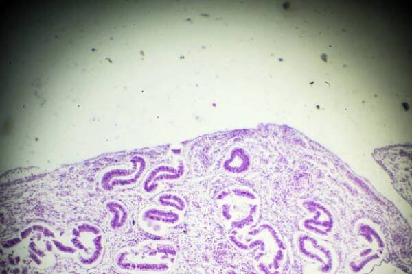 biopsie adenomyózy pod lehkou mikroskopií - myoma - stock snímky, obrázky a fotky