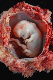 Soubor:Embryo - approximately 8 weeks from conception, 10 weeks estimated gestational age from LMP.jpg