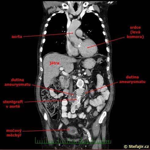 Nález 23 - Stentgraft aneurysmatu aorty | Medicína, nemoci, studium na 1. LF UK