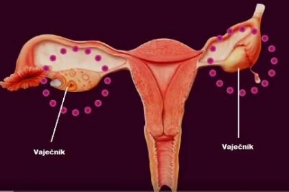 Rakovina vaječníků - příznaky, projevy, léčba