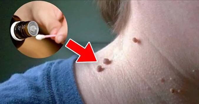Jak se šetrně domácími metodami zbavit jakýchkoliv druhů bradavic: Je to jednodušší, než se na první pohled zdá!