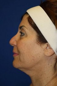 Neck Lift in Fort Lauderdale FL Before & After | Dr. Eberle | Page 1