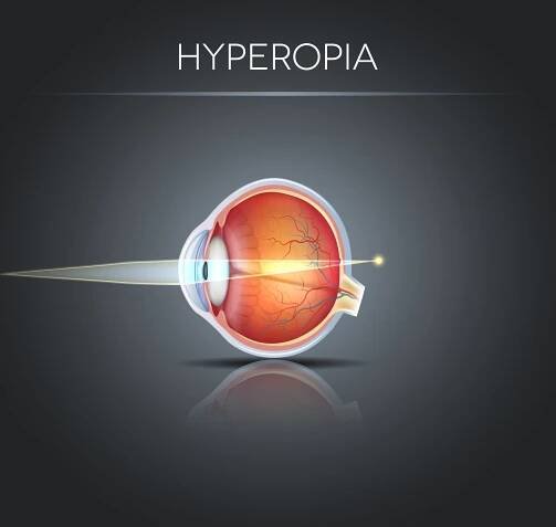 Refractive errors explained by Charl Laas Optometrists