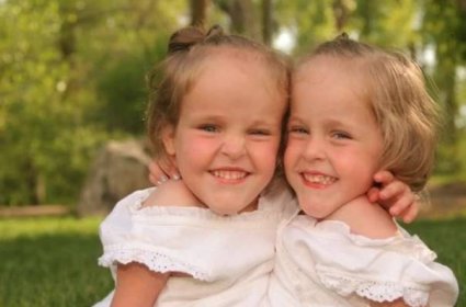 Siamská dvojčata byla rozdělena, když jím bylo 4 roky, nyní je jim už 18 let: Jak teď žijí - Zivot