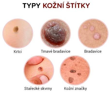 🔥Tekutý krém na bradavice k odstranění kožních bradavic – Melithea