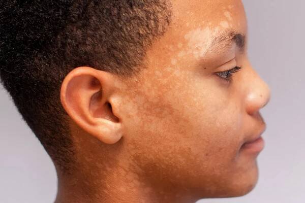 Tinea Versicolor: Cause, Symptoms, and Treatments