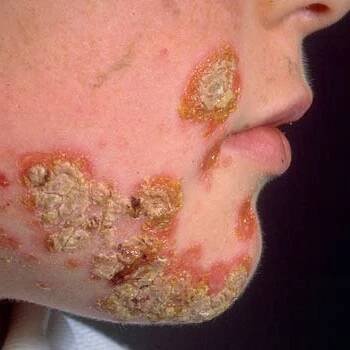 impetigo-contagiosa-priznaky-projevy-symptomy-obrazek-fotografie copy