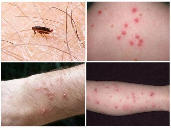 Jak vypadá bleší kousnutí u lidí: fotografie, příznaky a léčba