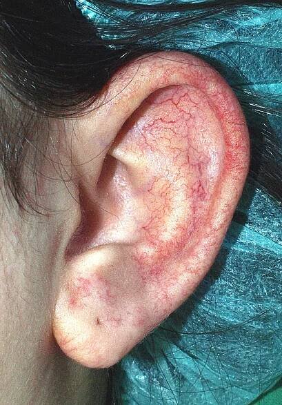 Generalized essential telangiectasia