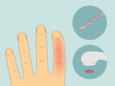 How to Prevent Hand Pain from Excessive Writing: 5 Best Ways