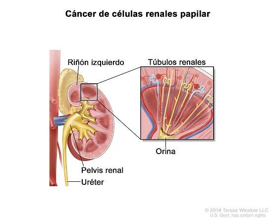 Síndromes hereditarios de cáncer de riñón