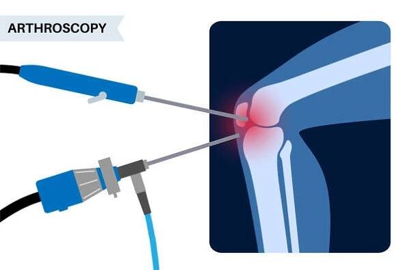 artroskopie kolenního kloubu - knee surgery stock ilustrace