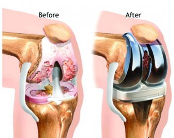 Vše o totální endoprotéze kolene (TEP)