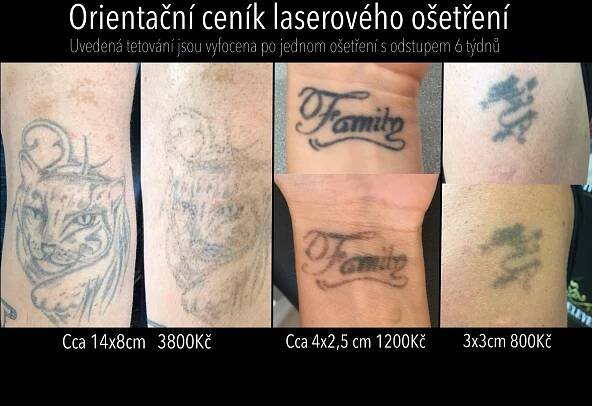 Laserové odstranění tetování – Tattoo Eleven