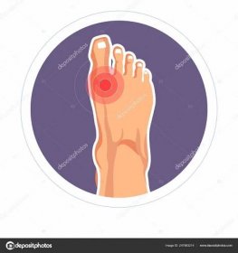 Artritida Nohy Poranění Kloubu Toe Bolesti Nebo Kostra Škody Vektorové