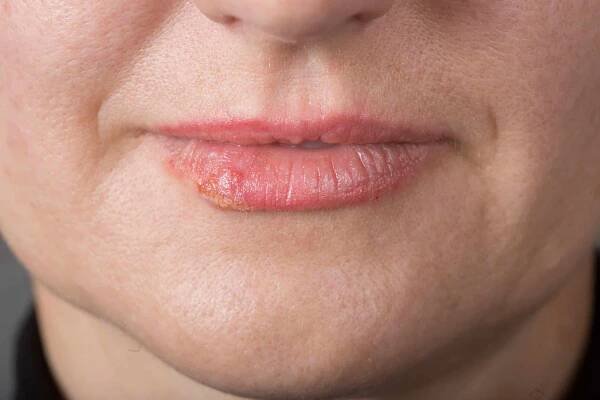 Cold Sores: Painful Fever Blisters