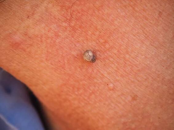 seborrheic keratosis removal at Skin Cancer Center of Central Florida