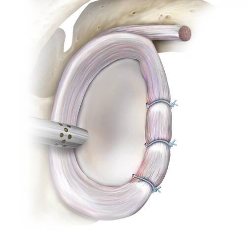 Labrum stabilizace Arthrex