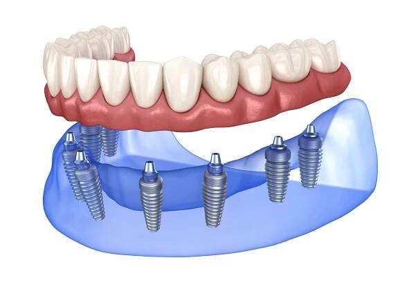 Maxilární a Mandibulární protéza s gumou Vše na 8 systému podporované implantáty. Lékařsky přesná 3D ilustrace lidských zubů a zubů — Stock obrázek