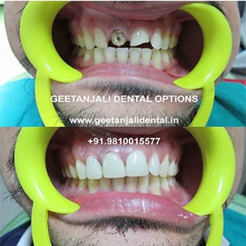 Painless Best Root Canal Treatment in Delhi by RCT Specialist