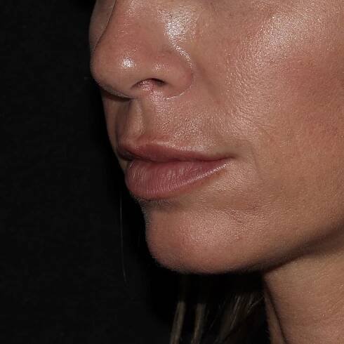 mo lip filler 10 before