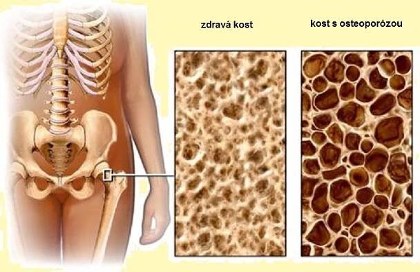 STRAŠÁK JMÉNEM OSTEOPORÓZA