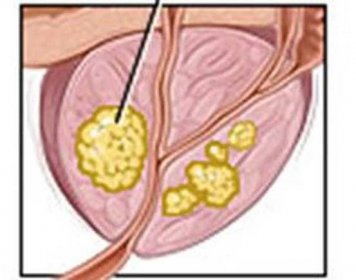 Příznaky rakoviny prostaty, stupně, stadia a léčba / Rakovina | Užitečné informace a tipy na péči o sebe. Zdraví, výživa