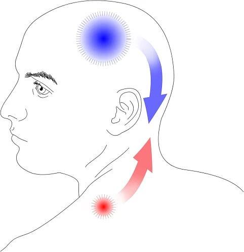 Myofascial trigger points in migraine and tension-type headache