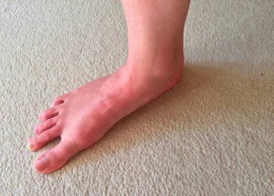 Jak uzdravit vbočený palec, klenby a problémy chodidel [Barefoot speciál 3]