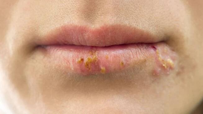 Herpes Simplex Virus