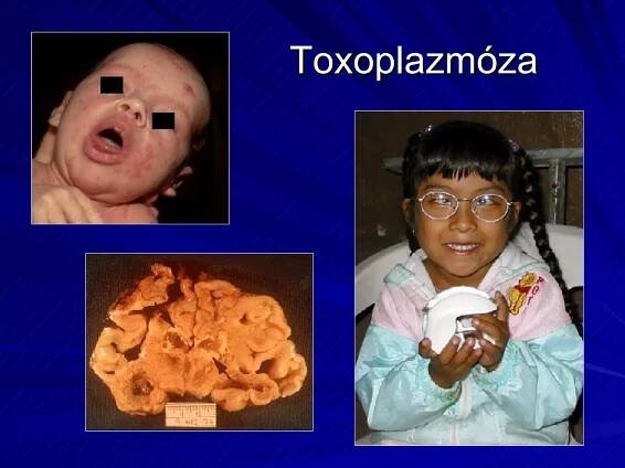 Toxoplazmóza 