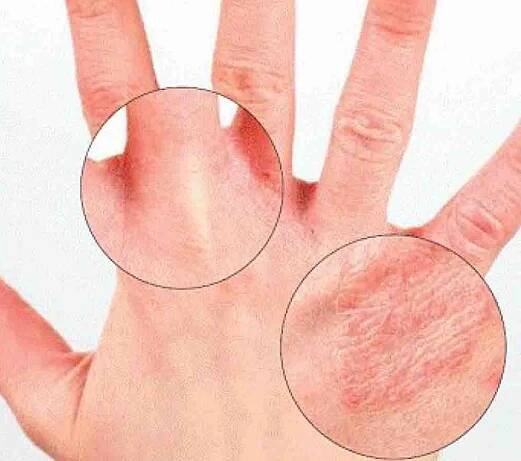 Psoriáza u dětí: příčiny a léčba, symptomy a příznaky u kojenců, jak se léčit, zda dětský krém pomáhá, zda je zděděn od