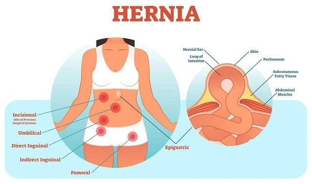 Pruh - hernia inguinale, hiatalis, umbilicalis