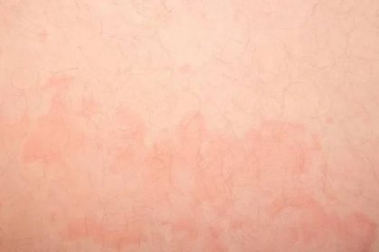 Kožní Onemocnění Urtikárie Kožní Červené Skvrny Svědění — Stock fotografie