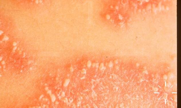 DermaCompass - Psoriasis vulgaris 
