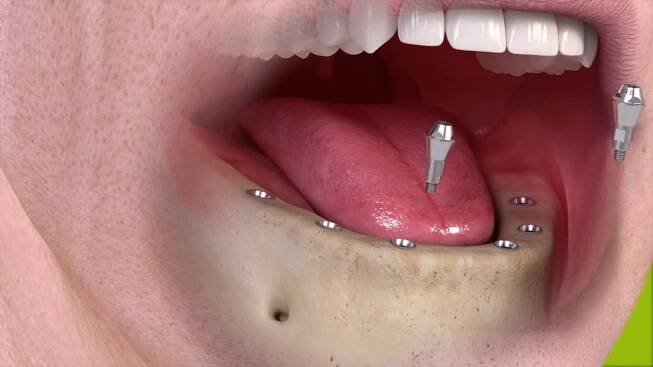 Ošetření bezzubé čelisti 6 implantátů