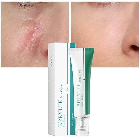 Acne Scar Removal Cream