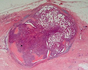 intraductal papilloma of breast pathology outlines)