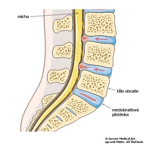 Bolesti zad | Medicína, nemoci, studium na 1. LF UK