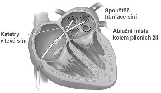 pv_ablation