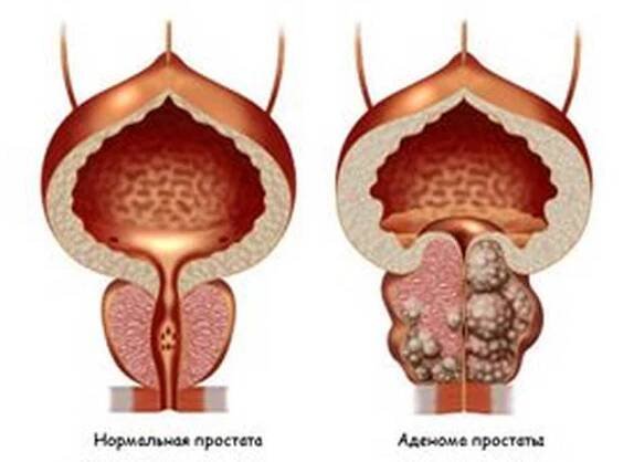 Symptomy a léčba adenomu prostaty u mužů / Adenom prostaty