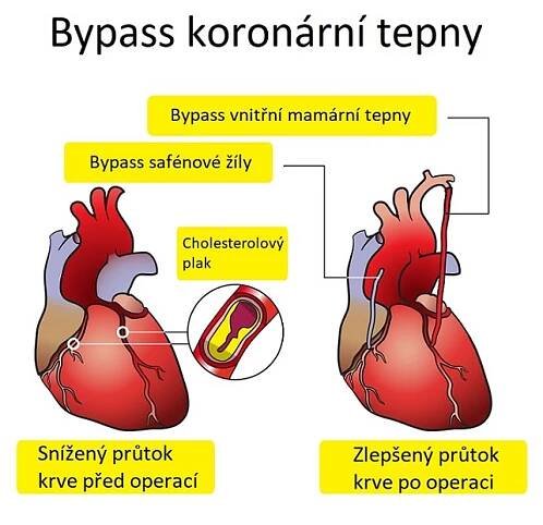 Co je koronární bypass či bypass srdce – kdy je potřeba?