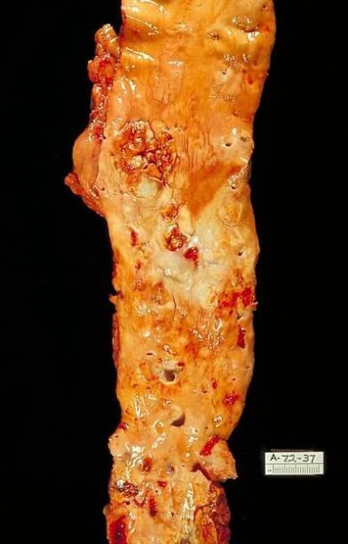 Súbor:Atherosclerosis, aorta, gross pathology PHIL 846 lores.jpg – Wikipédia