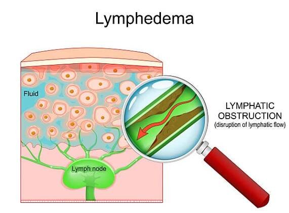 lymfedému. lymfatická céva s narušeným průtokem lymfy je viditelná přes lupu. - lipedém stock ilustrace