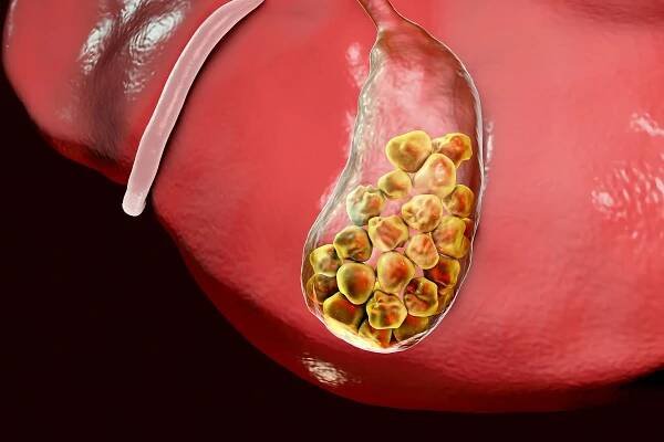 Gallstones (Cholelithiasis)